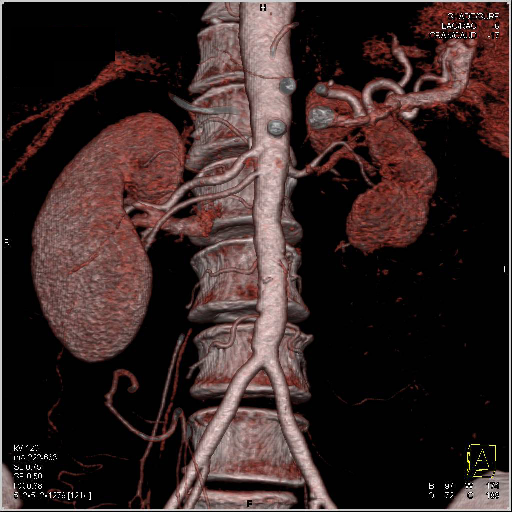 Retroperitoneal Fibrosis Encases the Aorta and Iliac Arteries - CTisus CT Scan