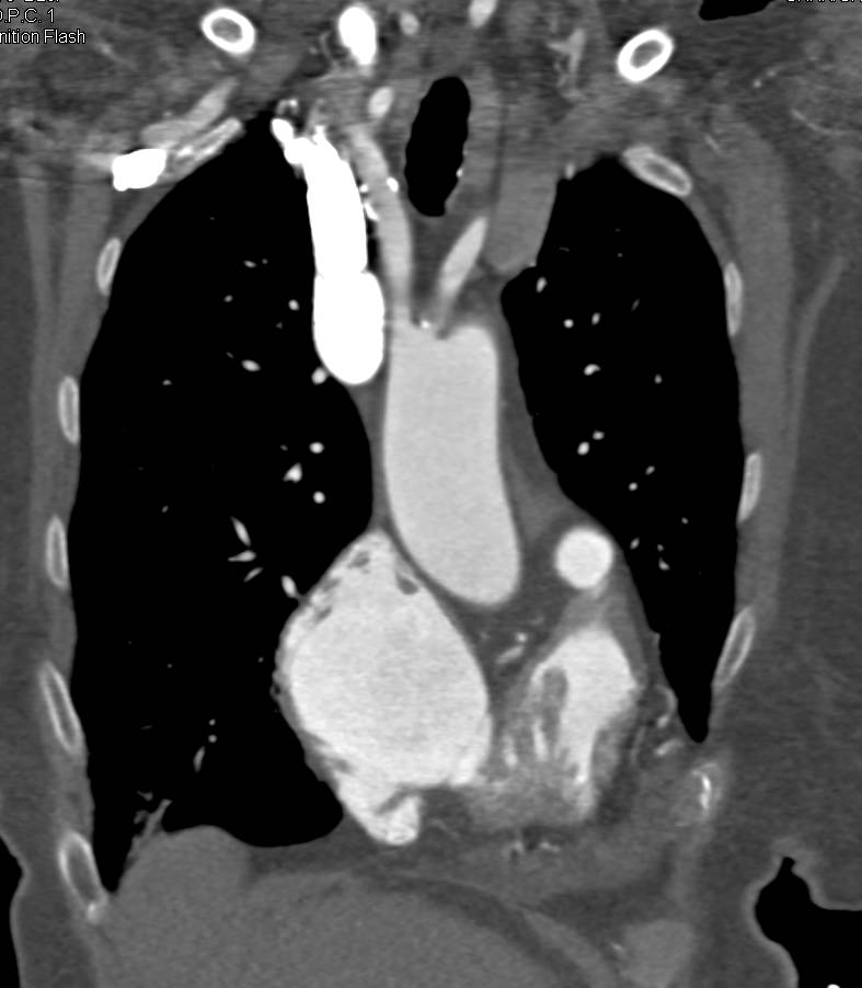 Vascular Mapping Aorta on a Flash Run - CTisus CT Scan