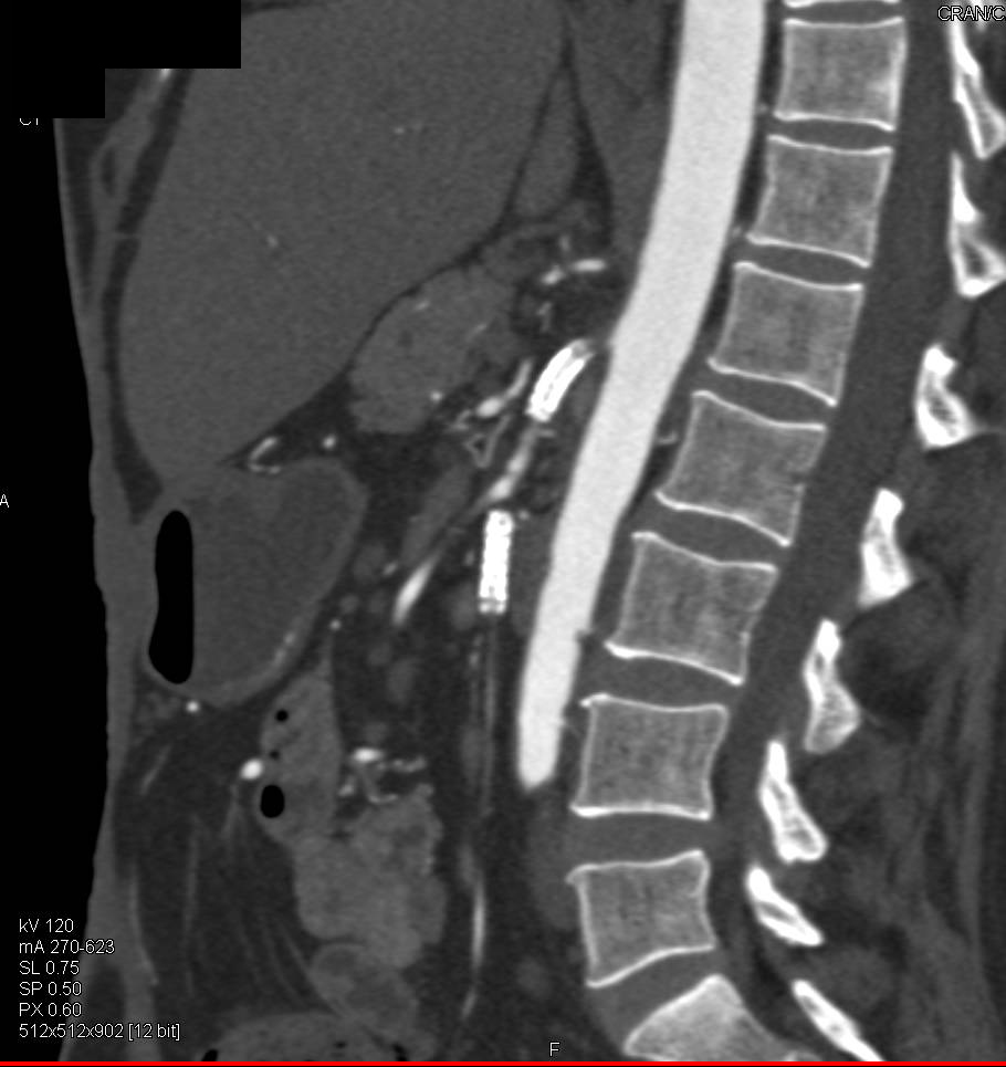 Occluded Proximal Celiac and Superior Mesenteric Artery (SMA) with Stent in the Vessels More Distally - CTisus CT Scan