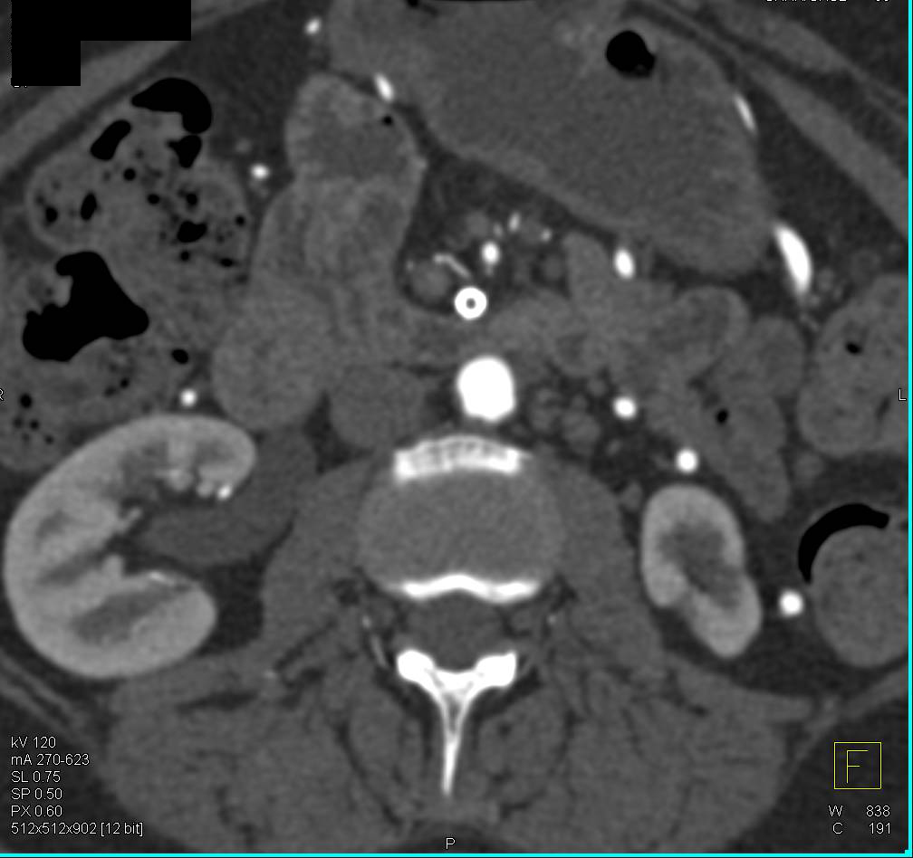 Multiple Mesenteric Stents and Stenosis with Collaterals in 3D - CTisus CT Scan