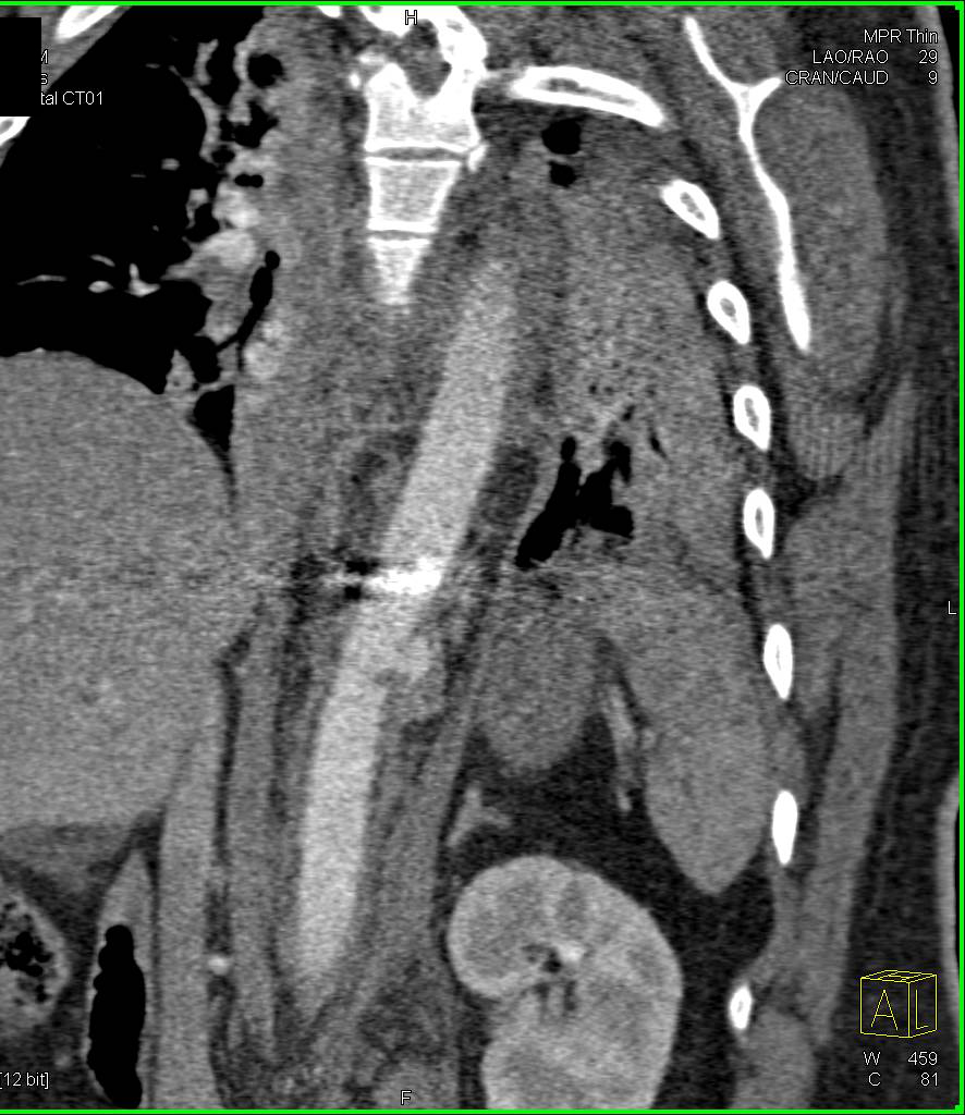 Ulceration with Intramural Hematoma Descending Thoracic Aorta - CTisus CT Scan