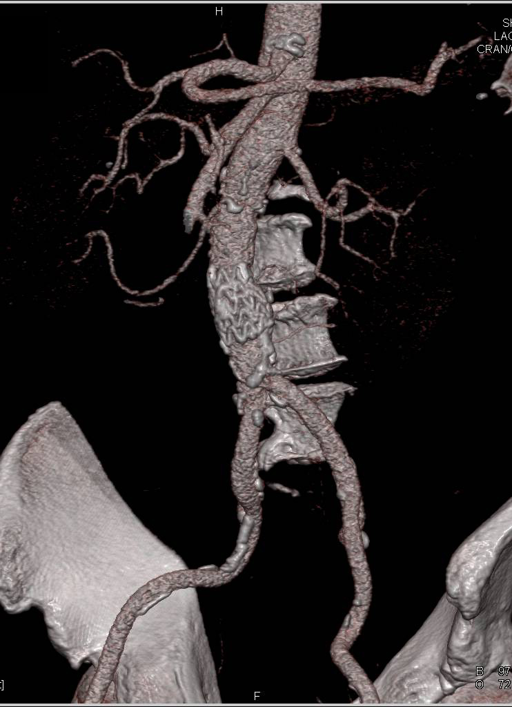 Endovascular Stent Without Complication - CTisus CT Scan