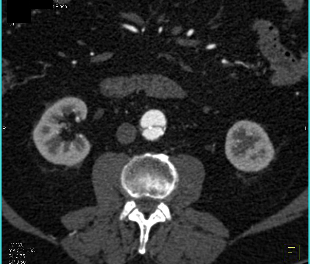 Aortic Dissection with Medially Placed Calcification - CTisus CT Scan