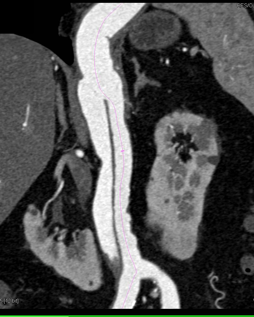 3D Map of Repair of Thoracic and Abdominal Aortic Aneurysms - CTisus CT Scan