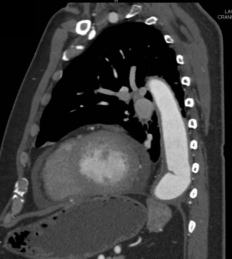 Abdominal Aortic Aneurysm with Dissection and Horseshoe Kidneys - CTisus CT Scan