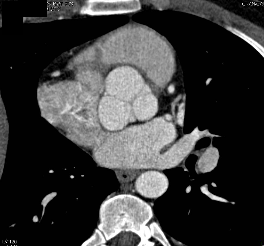 Marfan with Dilated Sinus of Valsalva - CTisus CT Scan
