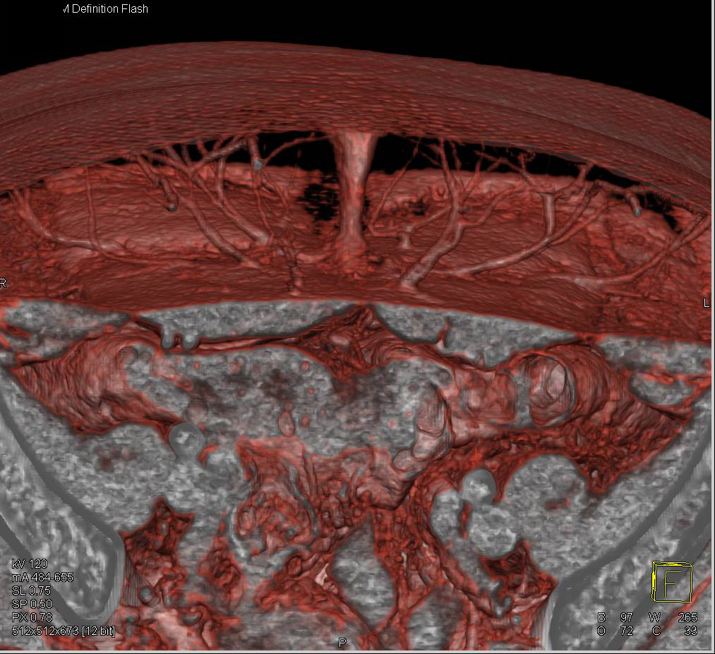 3D DIEP Flap Planning for Breast Reconstructive Surgery - CTisus CT Scan