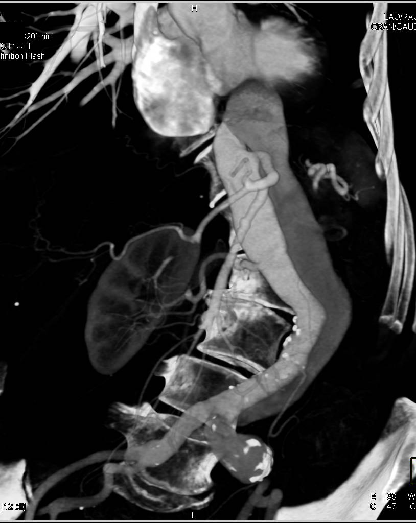 Type B Dissection Extends Through Abdominal Aorta - CTisus CT Scan
