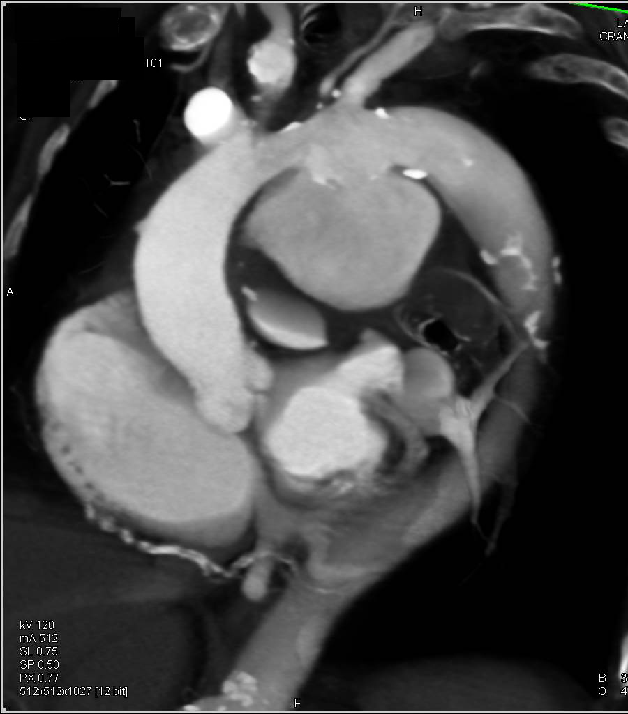 3D of Large Ductus Aneurysm - CTisus CT Scan