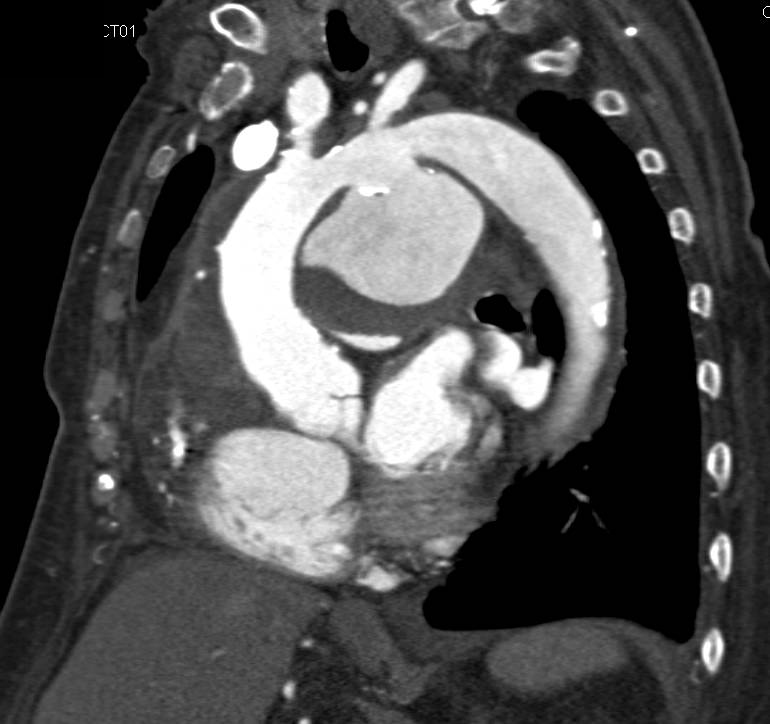 Large Ductus Aneurysm off the Arch - CTisus CT Scan