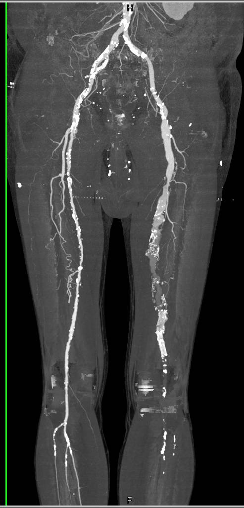 Peripheral Vascular Disease on Runoff - CTisus CT Scan