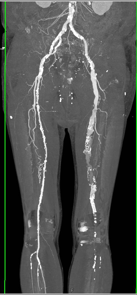 CTA Runoff with Peripheral Vascular Disease (PVD) and Stenosis with Occlusion of Left Popliteal Artery - CTisus CT Scan