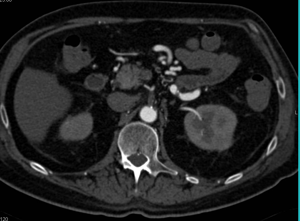 Celiac Occlusion with Collaterals - CTisus CT Scan