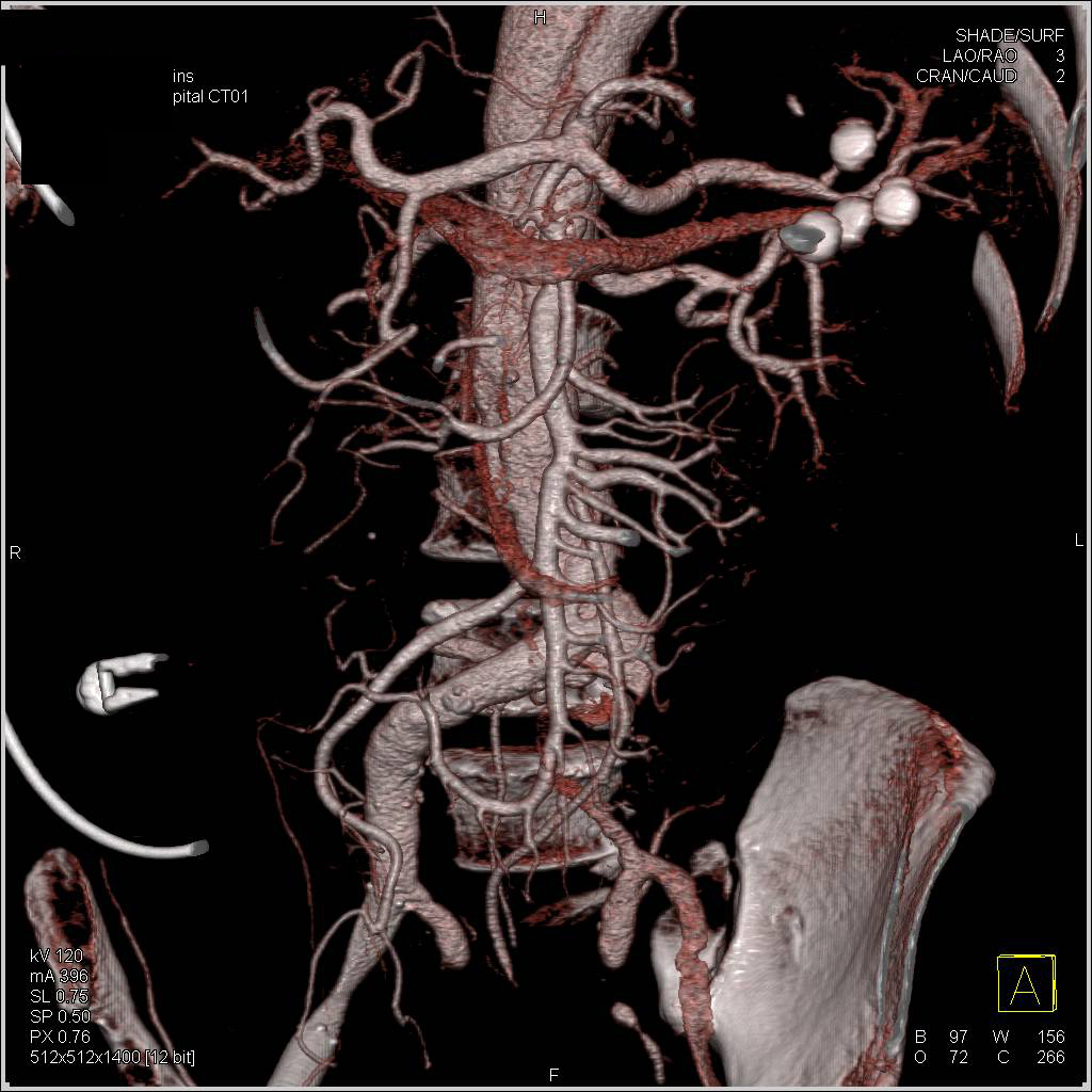 Occluded Left Iliac Artery with Fem-Fem Bypass and Jugular Vein Thrombosis (JVT) - CTisus CT Scan