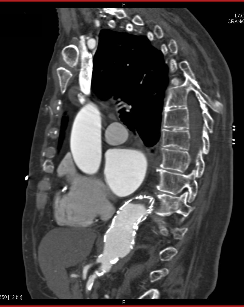 Center Line Tracking of Tortuous Aorta - CTisus CT Scan