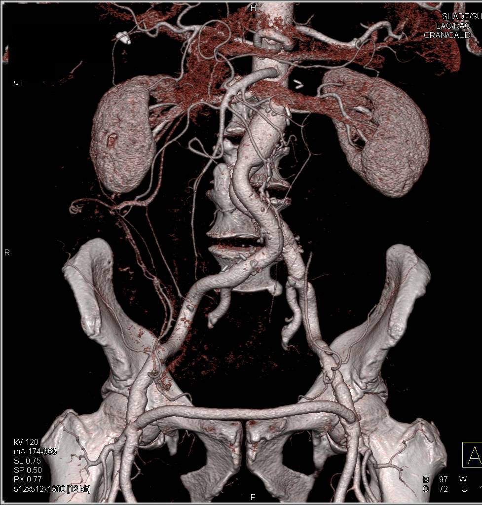 CTA with Aneurysm Repair and Fem-Fem Bypass - CTisus CT Scan