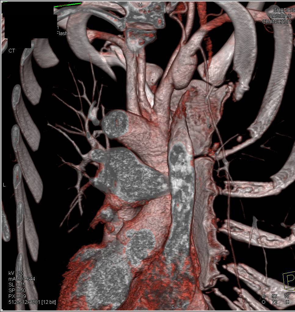 Aneurysm with Dissection Right Subclavian Artery - CTisus CT Scan