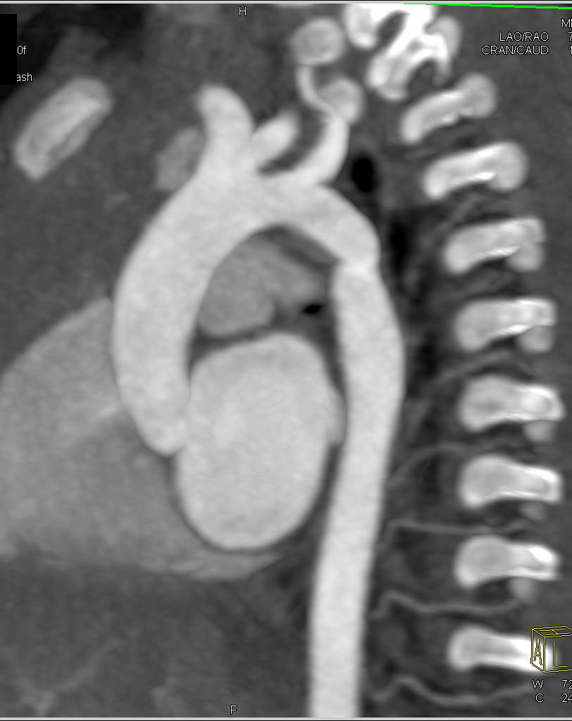 Routine Follow-Up Study in a Patient with Coarctation of the Aorta Repair - CTisus CT Scan