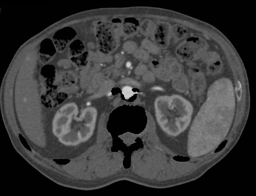 Dual Energy Runoff with Peripheral Vascular Disease (PVD) - CTisus CT Scan