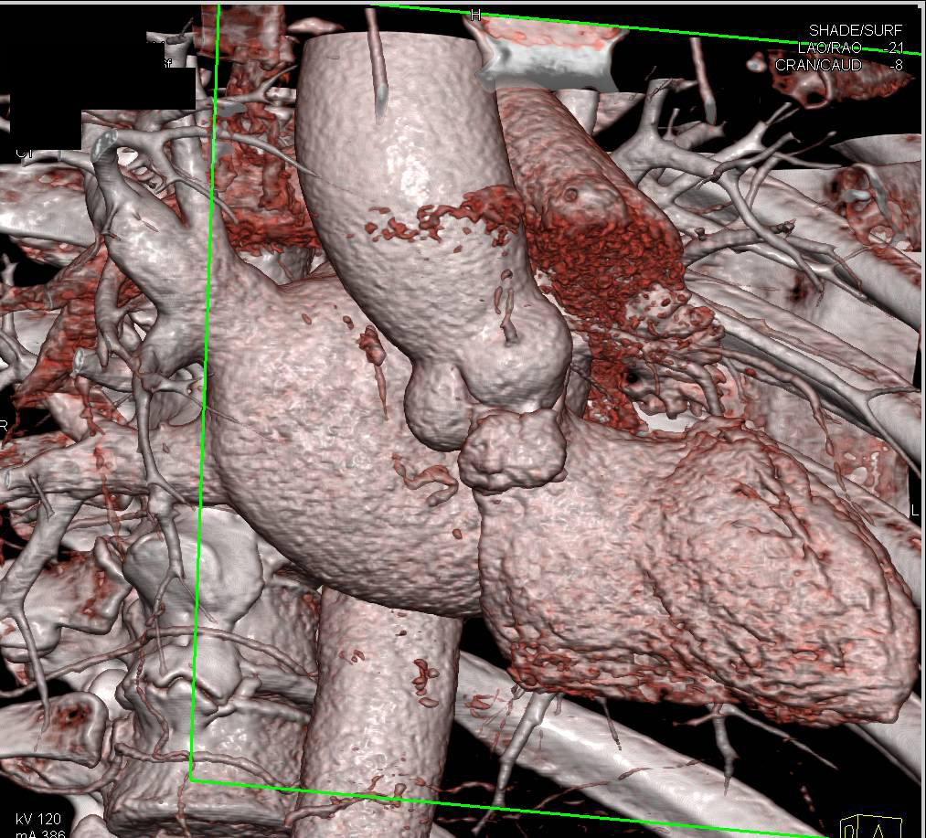 Focal Pseudoaneurysms off the Root - CTisus CT Scan