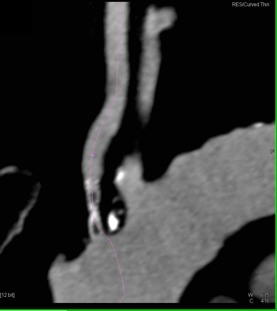 Vascular Disease Including Left Subclavian Artery Stenosis - CTisus CT Scan