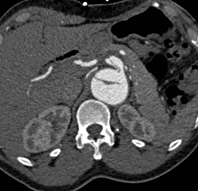 Aortic Dissection with Involvement of the Celiac Artery - CTisus CT Scan