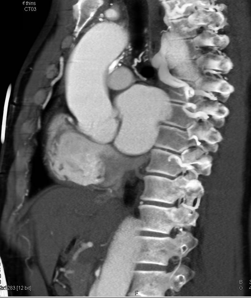 Aortic Dissection with Early and Late Phase Images - CTisus CT Scan