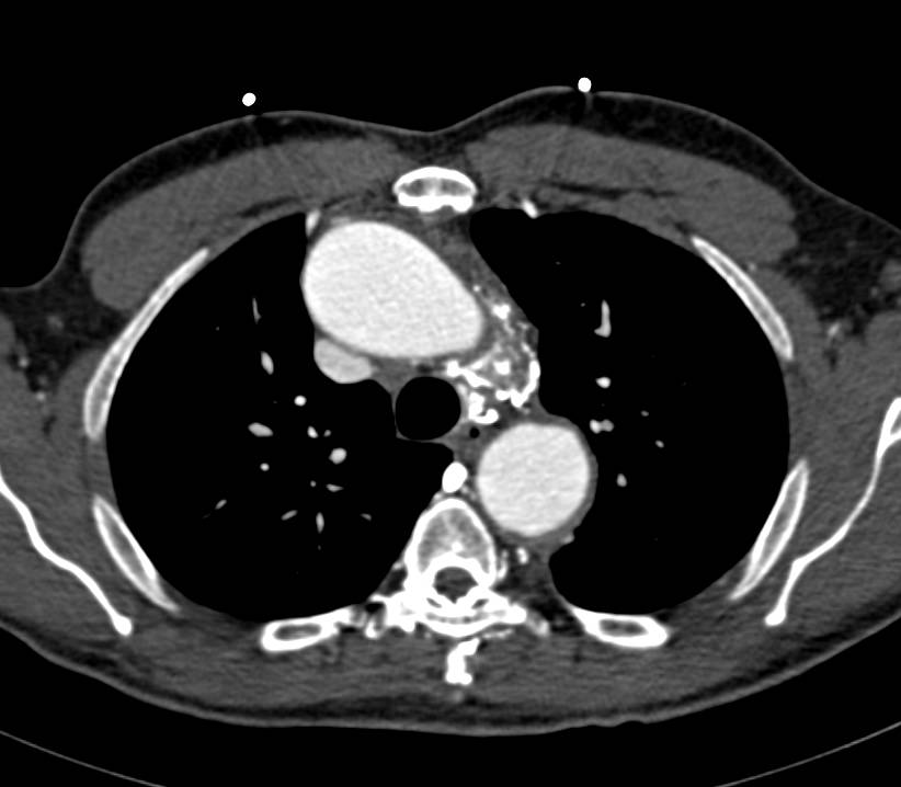 Aortic Dissection Extends into the Celiac Artery and the Right Renal Artery - CTisus CT Scan