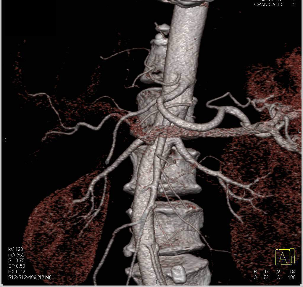 Unusual Origin of an Accessory Left Hepatic Artery - CTisus CT Scan