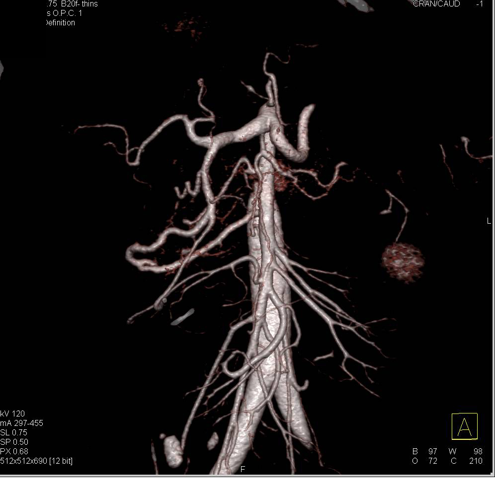 CTA with Prominent Gastroduodenal Artery (GDA) due to Celiac Artery Stenosis - CTisus CT Scan