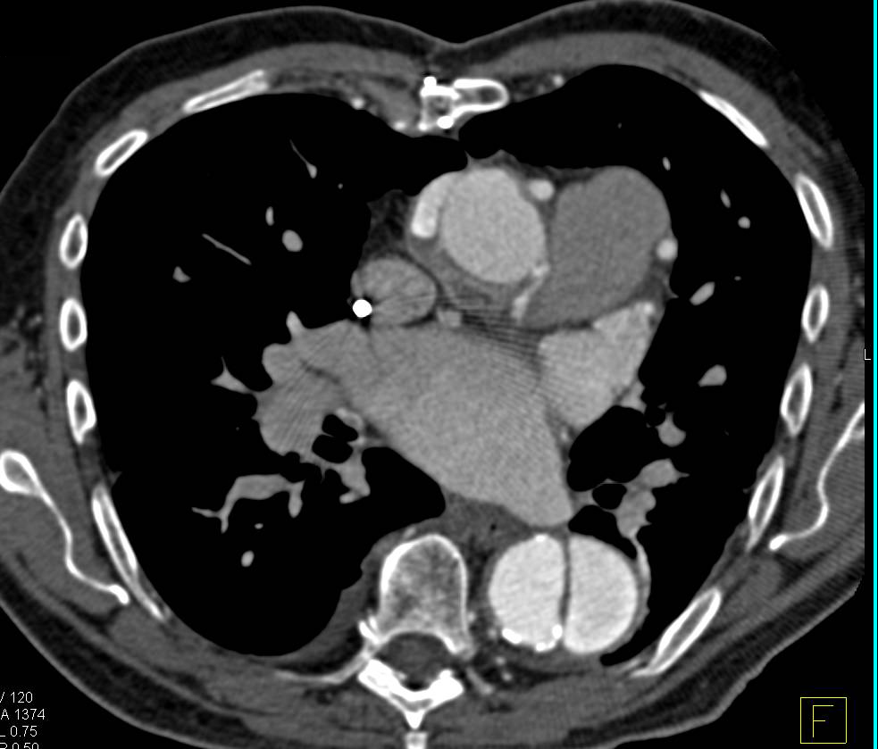 Type B Dissection and Right Iliac Aneurysm - CTisus CT Scan