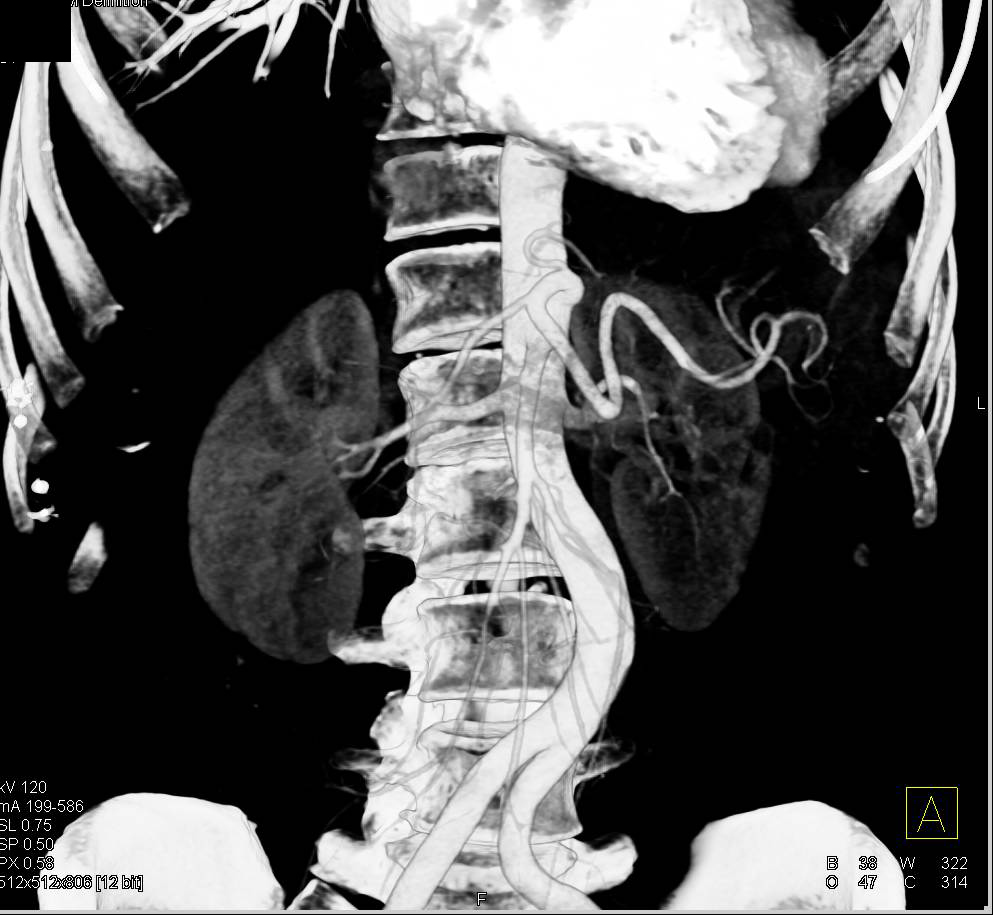 Renal Artery Stenosis - CTisus CT Scan