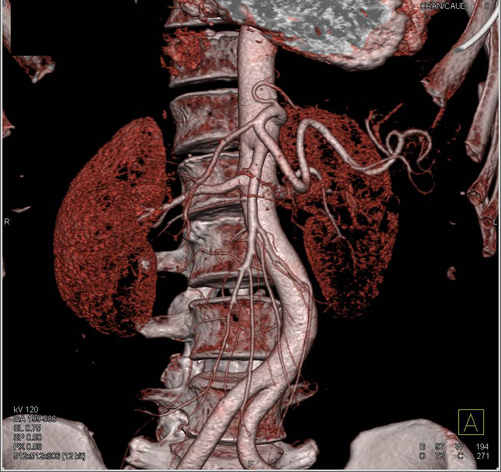 Renal Artery Stenosis - Vascular Case Studies - CTisus CT Scanning
