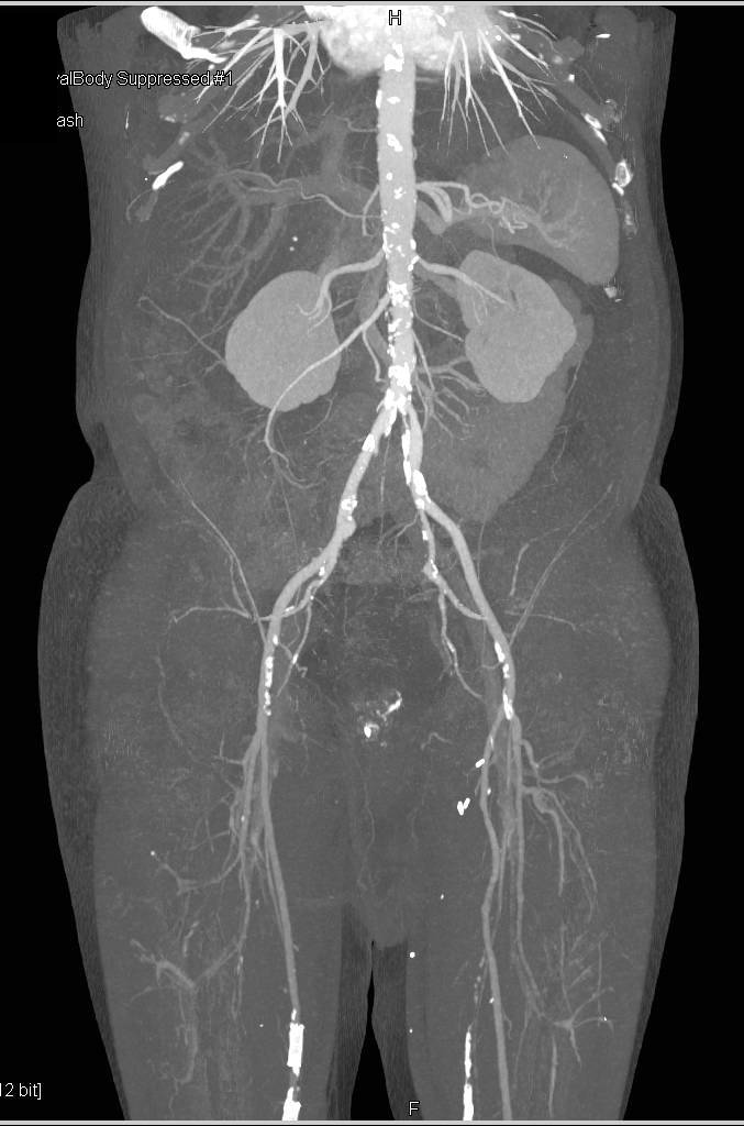 CTA Runoff with Stent in Arteries - CTisus CT Scan