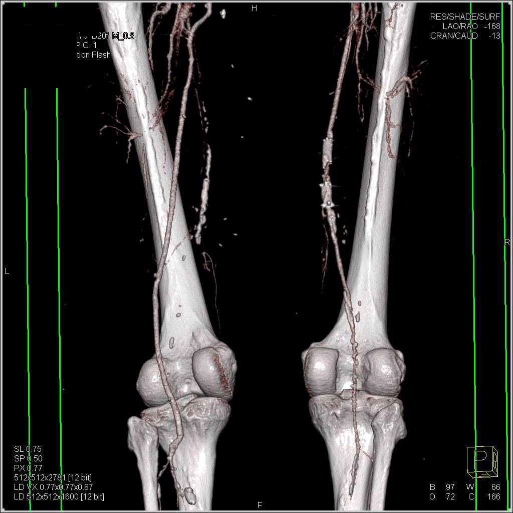 CTA Runoff with Peripheral Vascular Disease (PVD) and Stents and Bypass Grafts - CTisus CT Scan