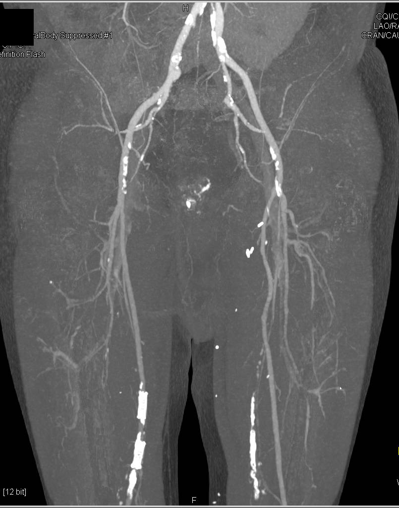 Dual Energy Runoff for Peripheral Vascular Disease - CTisus CT Scan