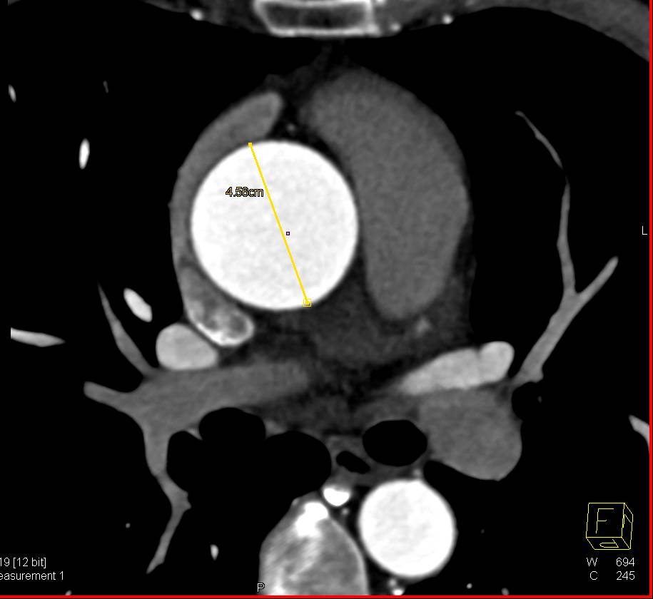 Dilated Ascending Aorta with Bicuspid Aortic Valve - CTisus CT Scan