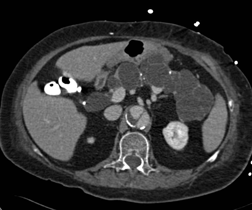 Aortic Dissection S/P Repair with Incidental Detection of Multiple Pancreatic Cysts - CTisus CT Scan