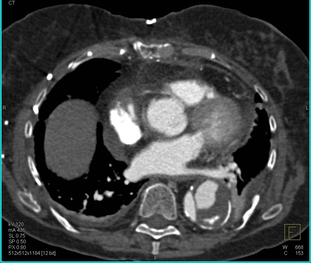 Type-B Dissection - CTisus CT Scan