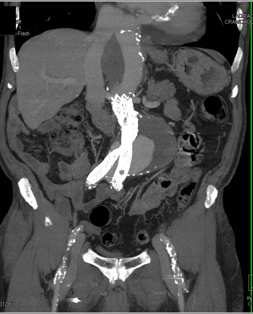 Type II Endovascular Leak - CTisus CT Scan