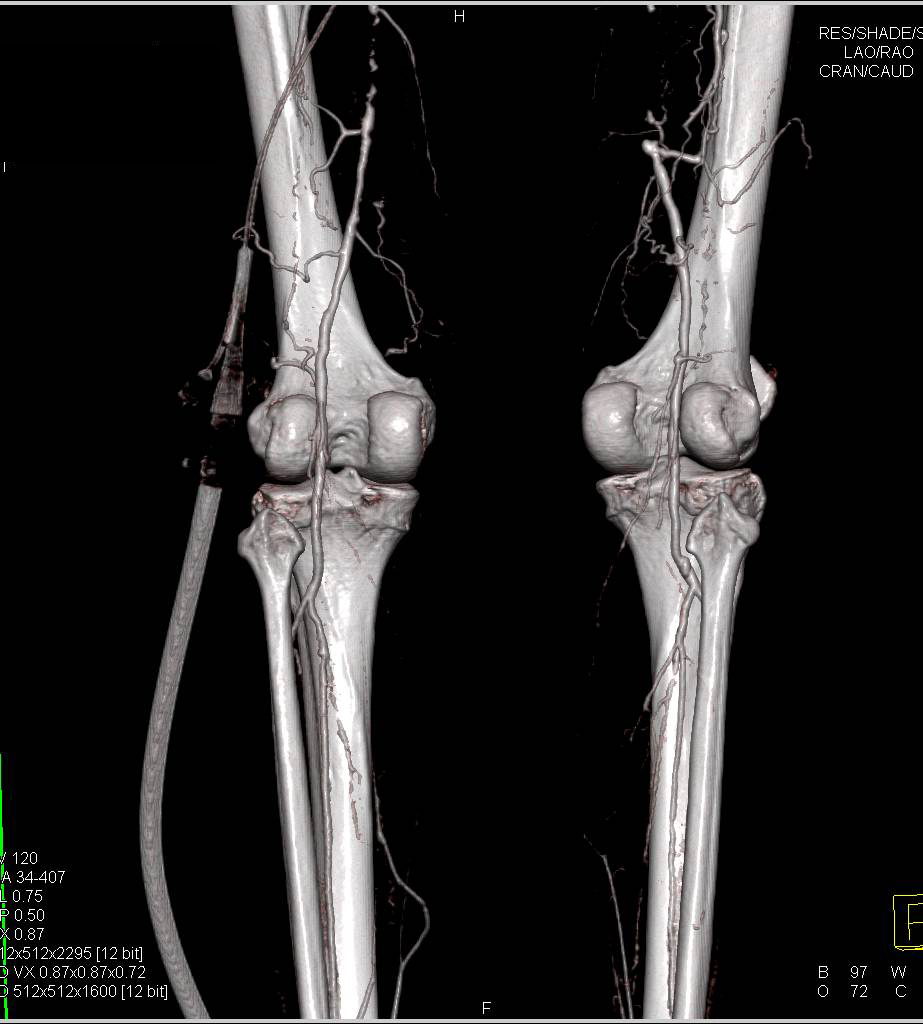 CTA Runoff with Extensive Peripheral Vascular Disease (PVD) with Superficial Femoral Artery (SFA) Occlusion - CTisus CT Scan