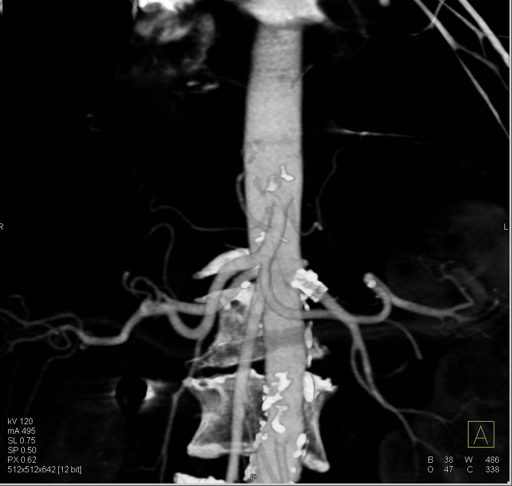 Patent Stent in Left Renal Artery - CTisus CT Scan