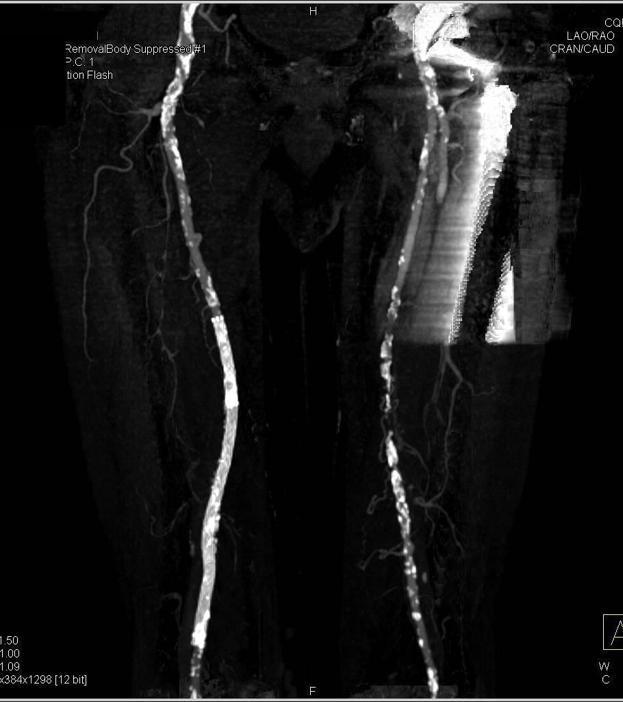 CTA Runoff With Patent Stent in Right Superficial Femoral Artery (SFA) with Vessel Mapping - CTisus CT Scan