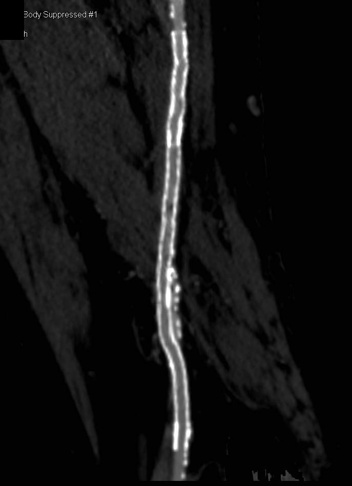 Vascular Patentcy in Stent Defined with Center Line - CTisus CT Scan