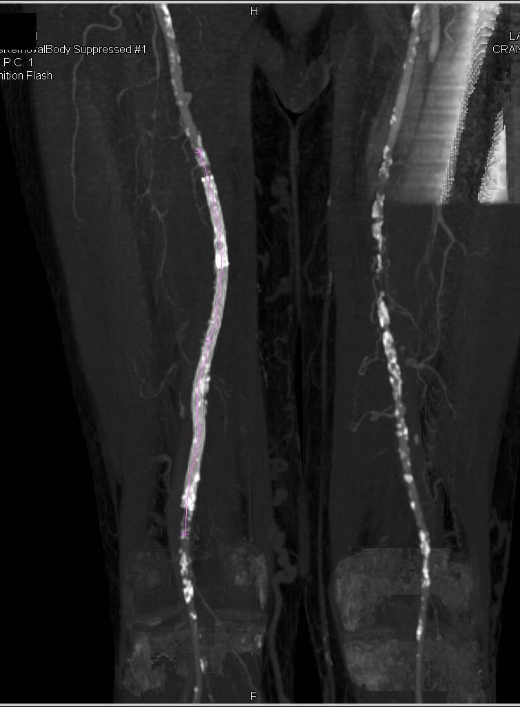 CTA Runoff with Peripheral Vascular Disease (PVD) and Multiple Stents and Stenosis - CTisus CT Scan