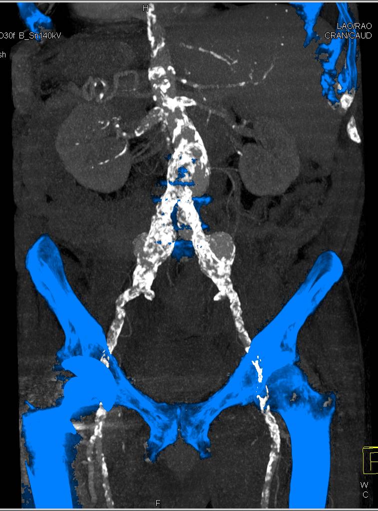 CTA with Iliac Artery Aneurysms with Automated Bone Removal - CTisus CT Scan