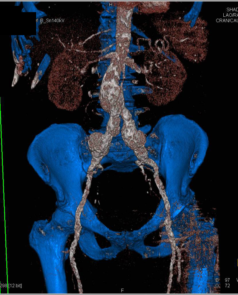 Extensive Vascular Calcification and Iliac Artery Aneurysms - CTisus CT Scan