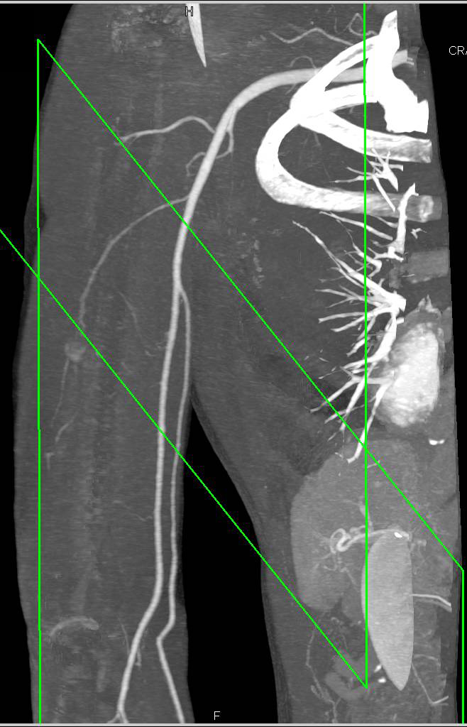 CTA with Bone Edits of Normal Axillary, Brachial and Radial and Ulnar Arteries - CTisus CT Scan