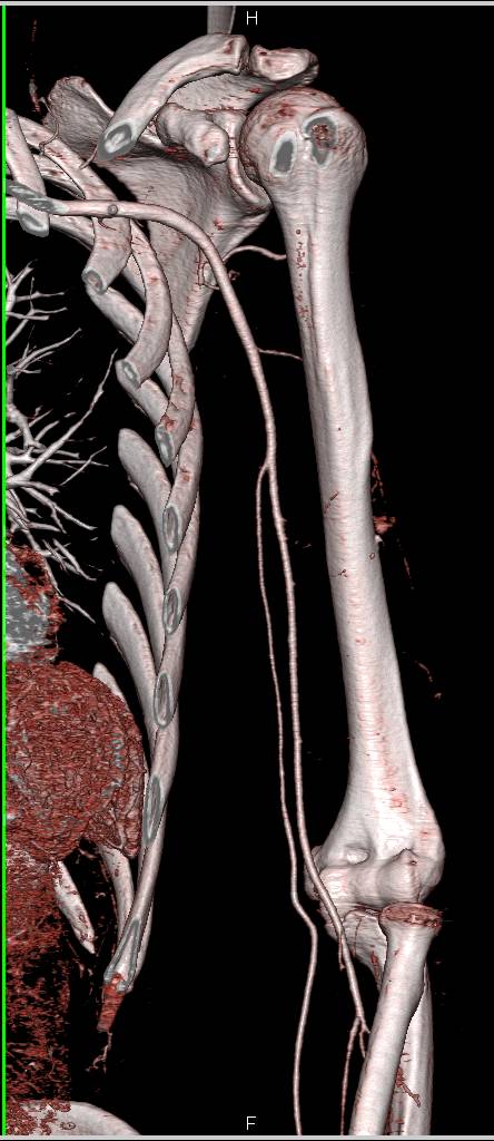 CTA of Brachial Artery and Branching into the Radial and Ulnar Artery - CTisus CT Scan