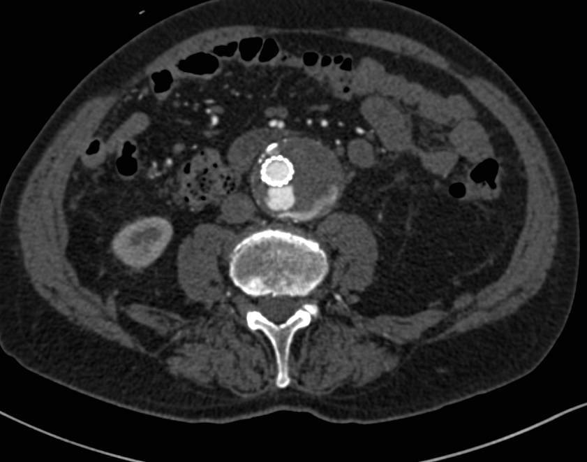 Aortic Aneurysm Repair With Endovascular Stent with Endoleak - CTisus CT Scan